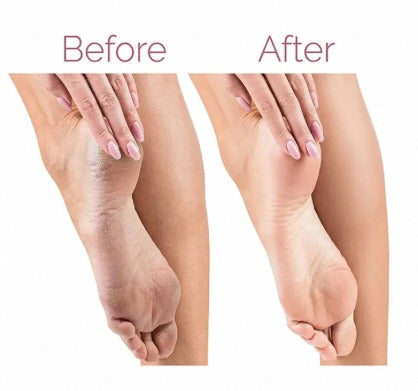 Rechargeable Electric Callus Remover